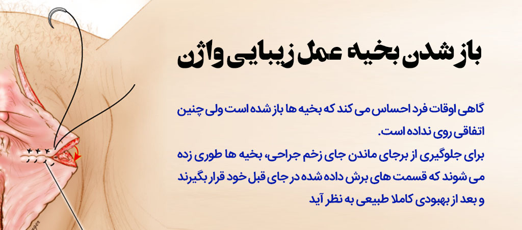 فیلم و عکس عمل زیبایی واژن با بخیه